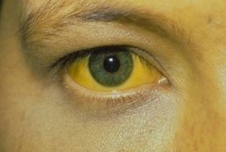 Photo of person with jaundice.